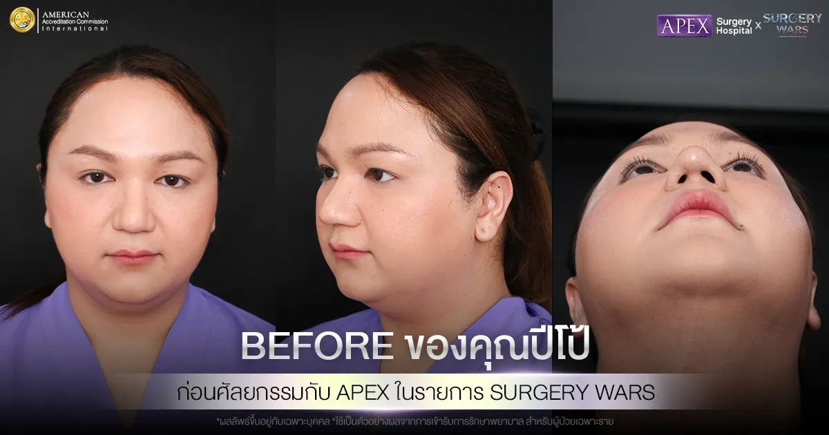 ภาพคุณปีโป้ก่อนศัลยกรรมกับ APEX