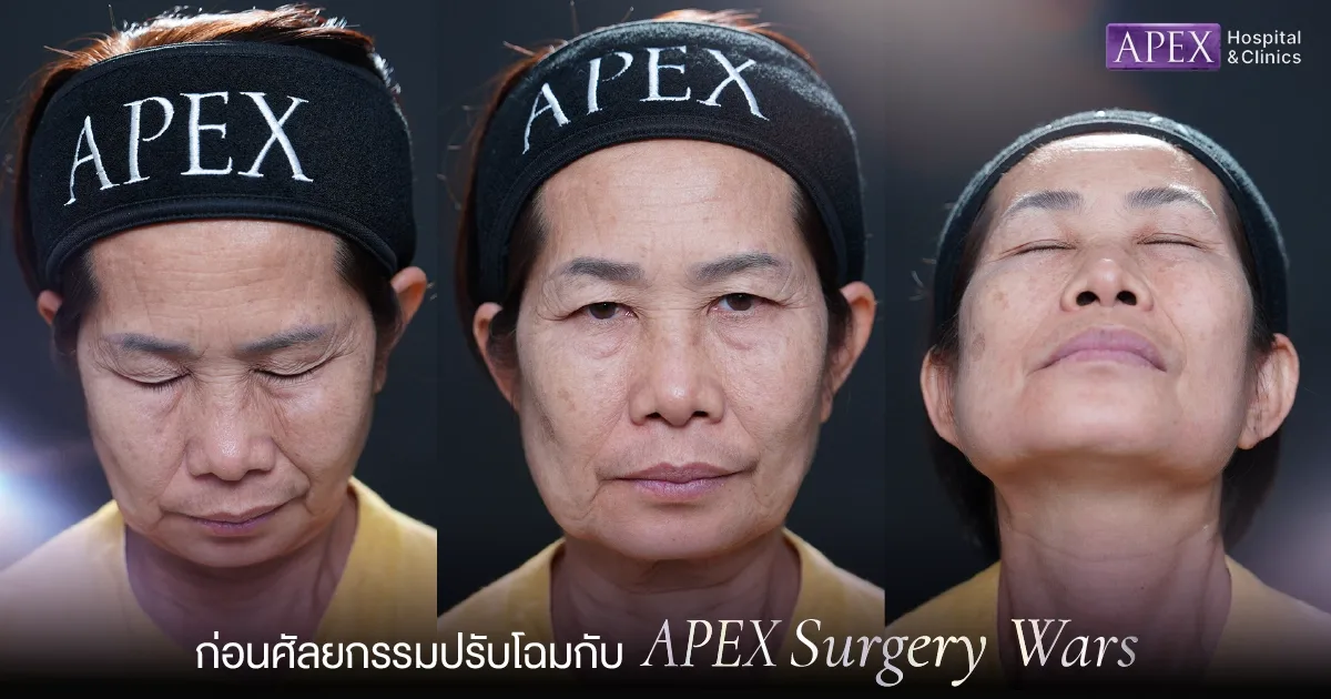 ภาพ Before ของคุณดาก่อนศัลยกรรมกับ APEX