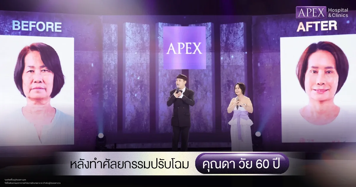 ผลลัพธ์ Before After คุณดา หลังทำศัลยกรรมที่ APEX