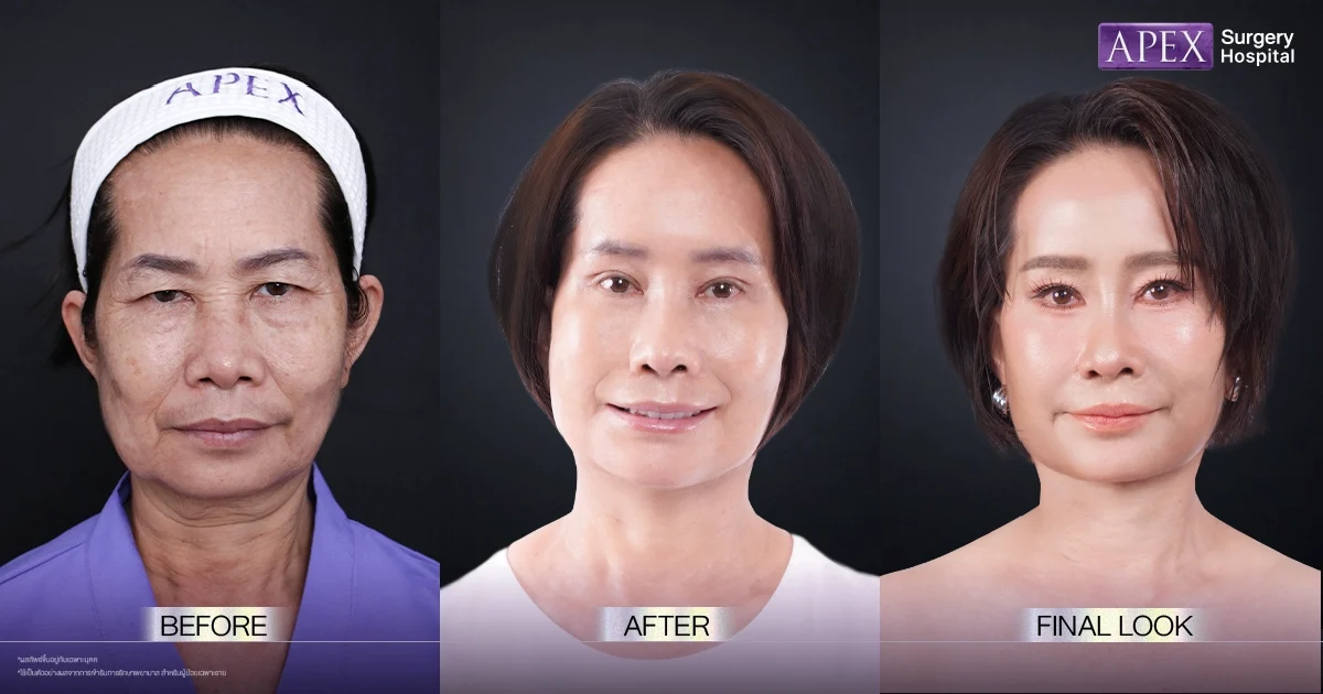 ผลลัพธ์ Before After คุณดา หลังทำศัลยกรรมที่ APEX