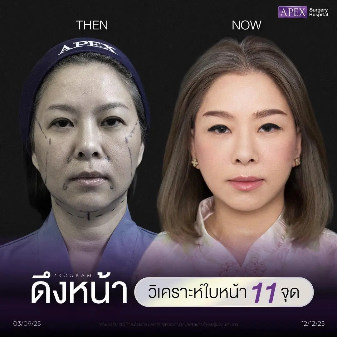 วิเคราะห์ใบหน้า 11 จุด