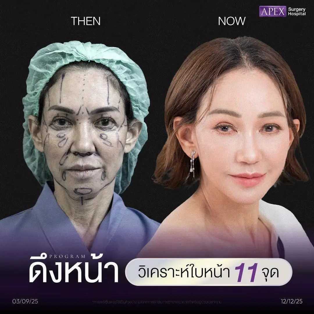 วิเคราะห์ใบหน้า 11 จุด