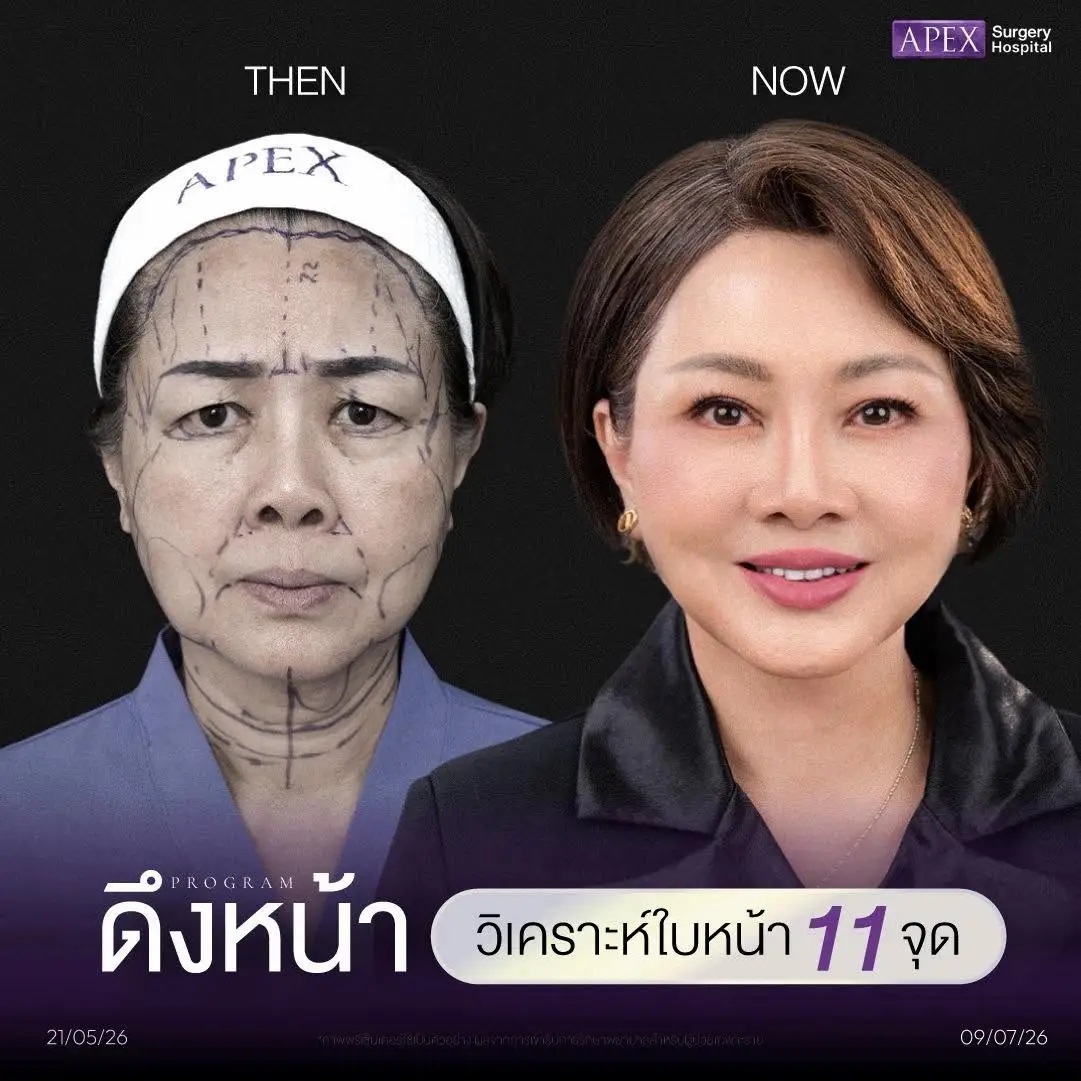 วิเคราะห์ใบหน้า 11 จุด