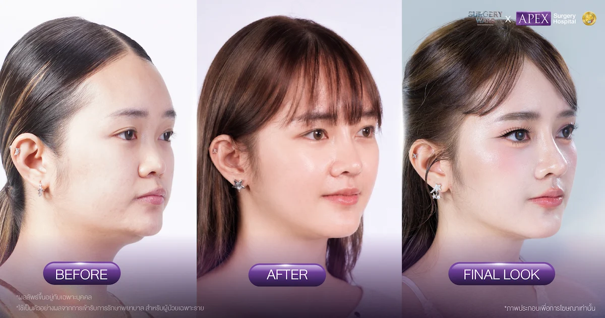 คุณป๊อบ ก่อนและหลังทำศัลยกรรมกับ APEX Surgery Wars EP4