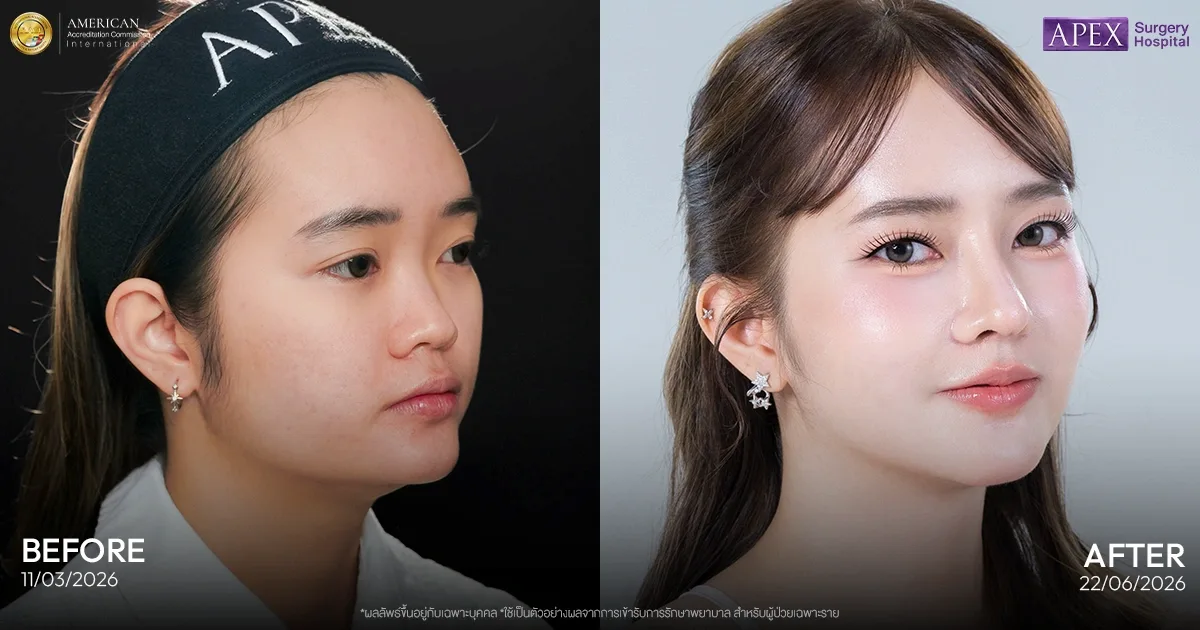 รีวิวคุณป๊อบ ศัลยกรรมกระดูกคาง เทคนิค Sliding Genioplasty
