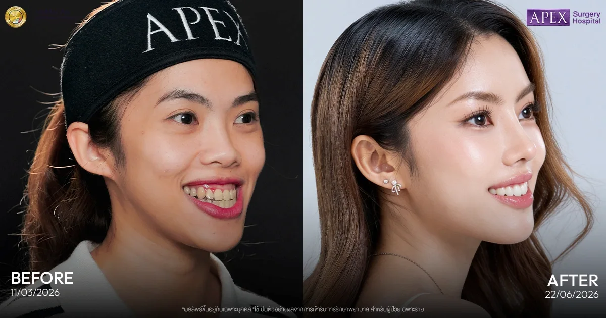 รีวิวคุณยุ้ย ศัลยกรรมกระดูกขากรรไกร