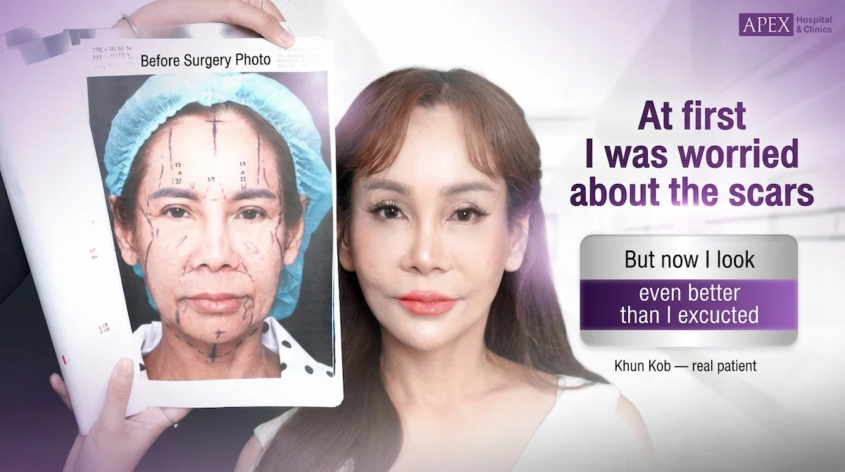 Characteristics of Facelift Scars