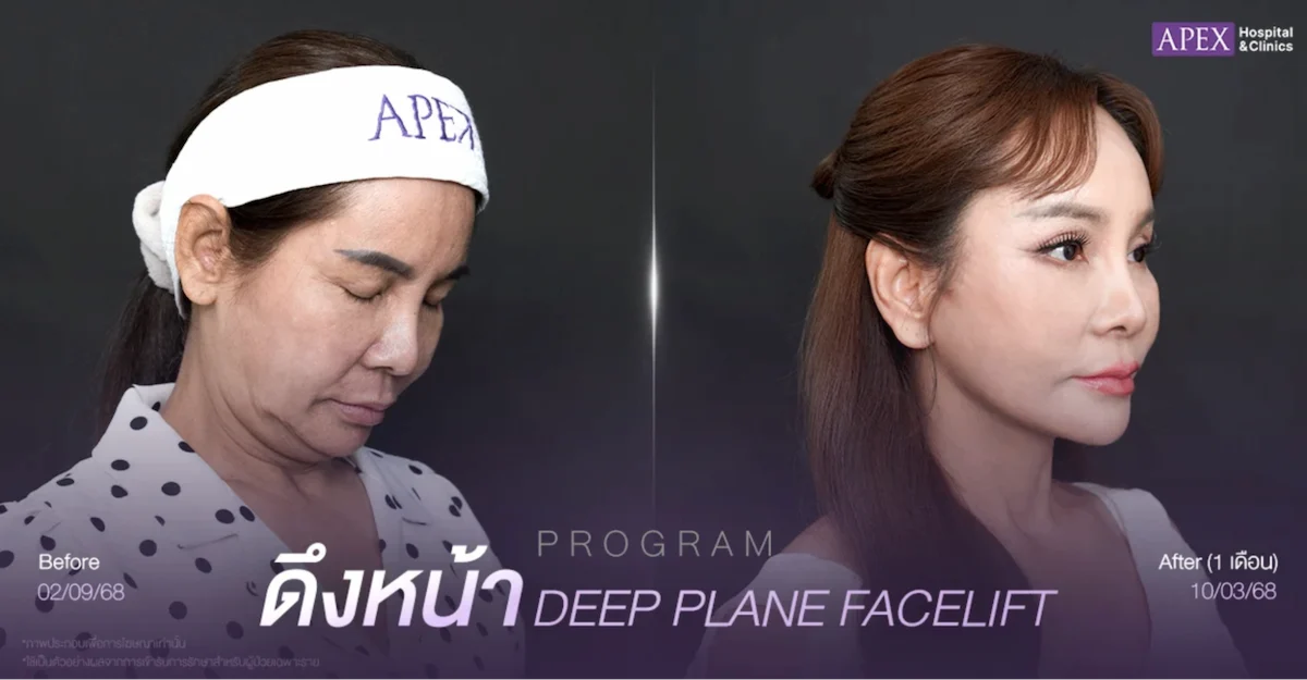 How to Care for Yourself After a Facelift