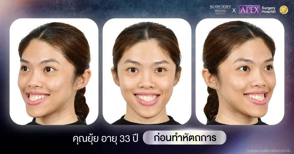 รีวิวเคสคุณยุ้ย