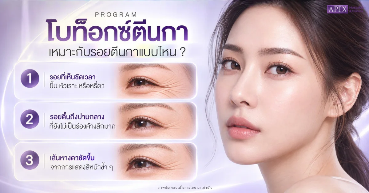รอยตีนกาแบบไหนที่เหมาะกับการฉีดโบท็อกตีนกา