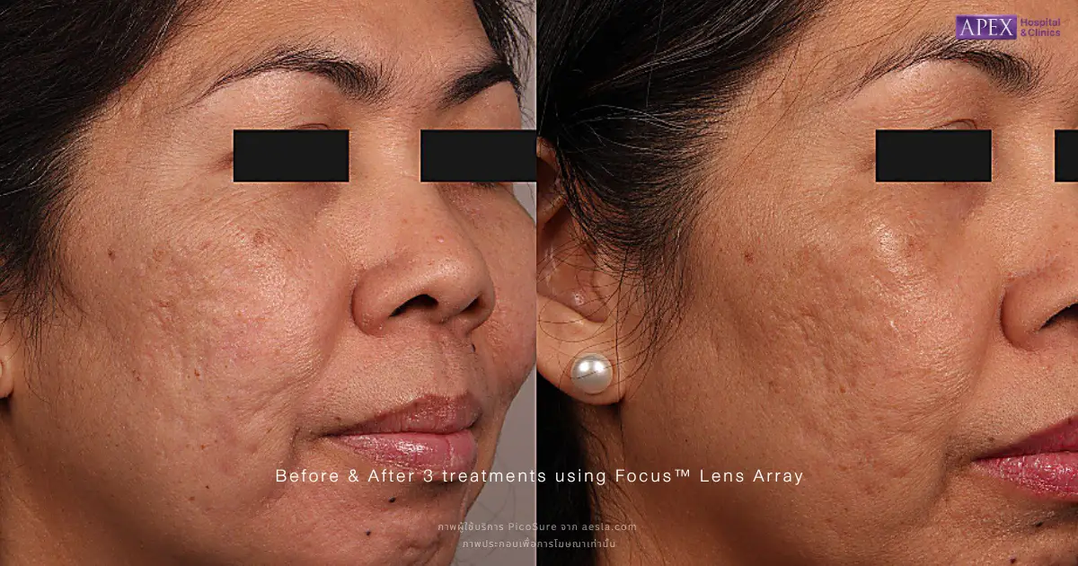 รีวิว PicoSure