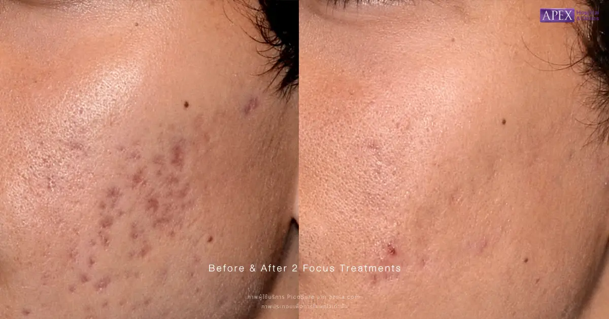 รีวิว PicoSure
