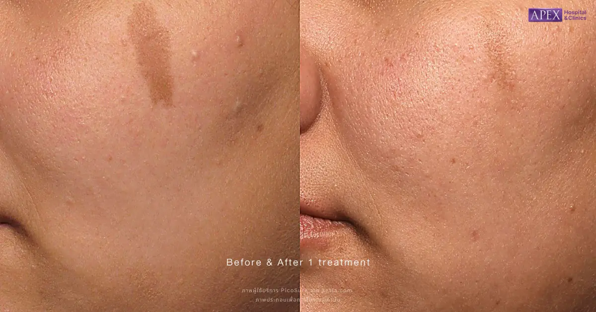 รีวิว PicoSure