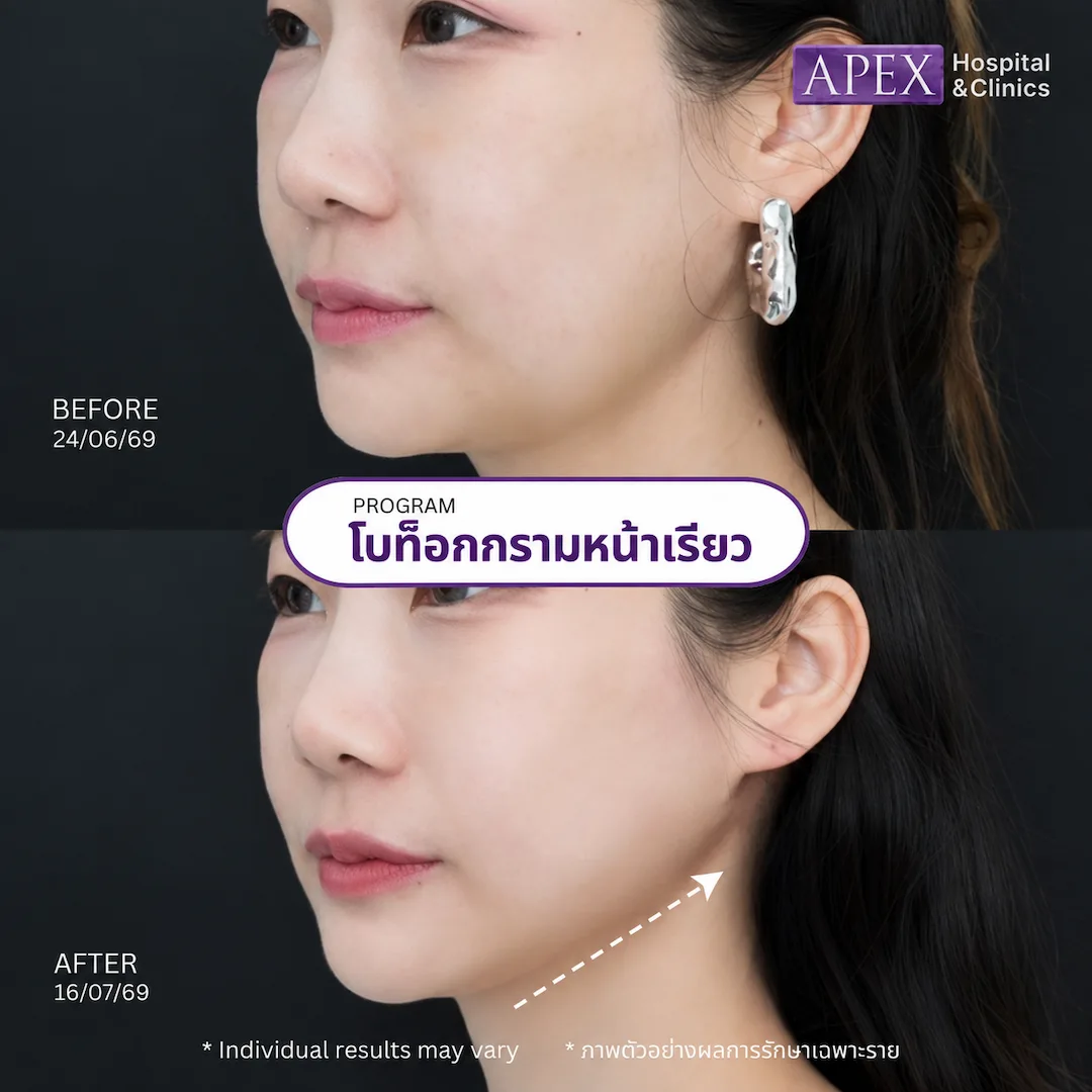 รีวิวโบท็อกหน้าเรียว
