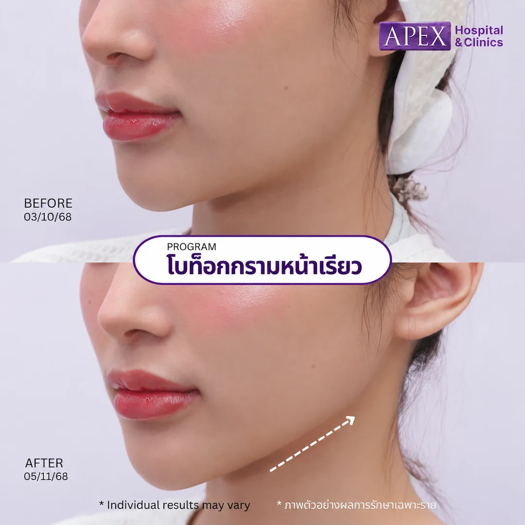 รีวิวโบท็อกหน้าเรียว
