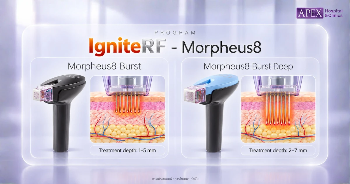 IgniteRF กลุ่ม Morpheus8
