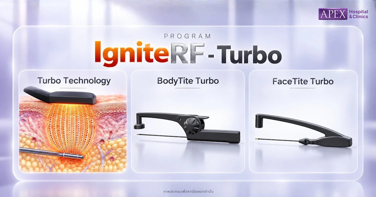IgniteRF กลุ่ม Turbo