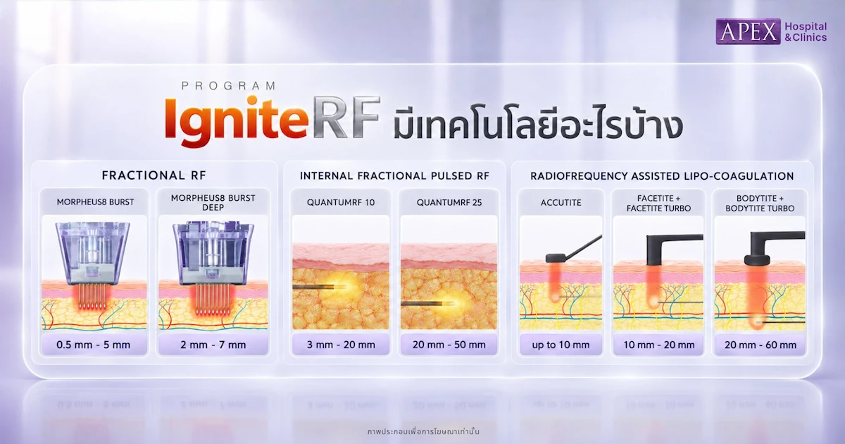 IgniteRF มีเทคโนโลยีอะไรบ้าง