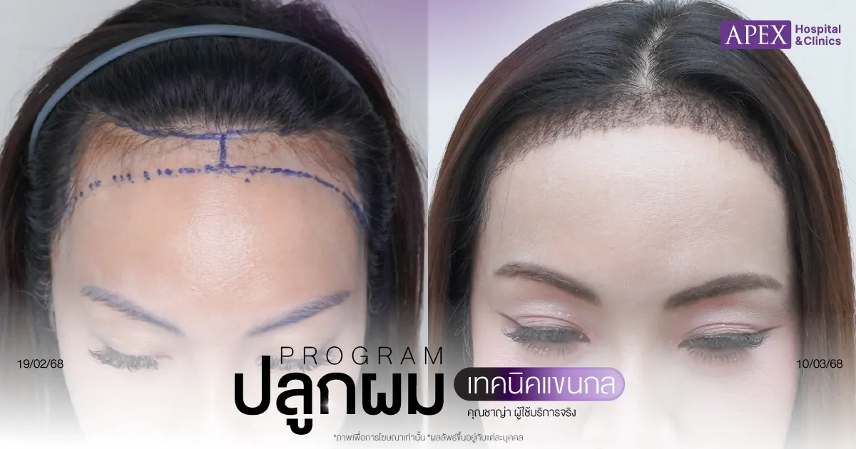 รีวิวปลูกผมคุณชาญ่า