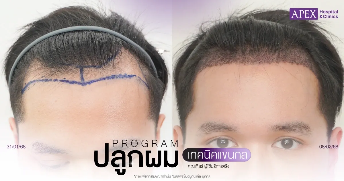 รีวิวปลูกผมคุณเกียร์