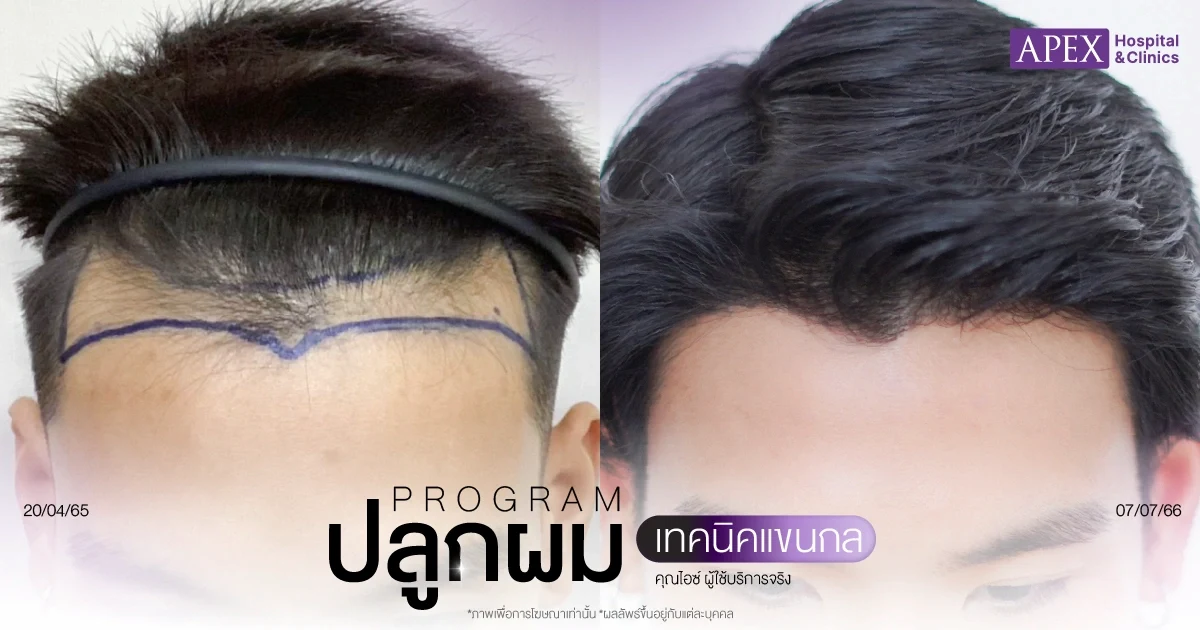 รีวิวปลูกผมคุณไอซ์