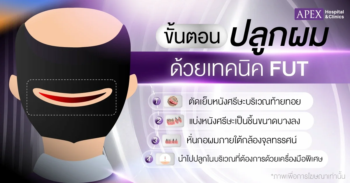 ขั้นตอนการทำโปรแกรมปลูกผมเทคนิค FUT