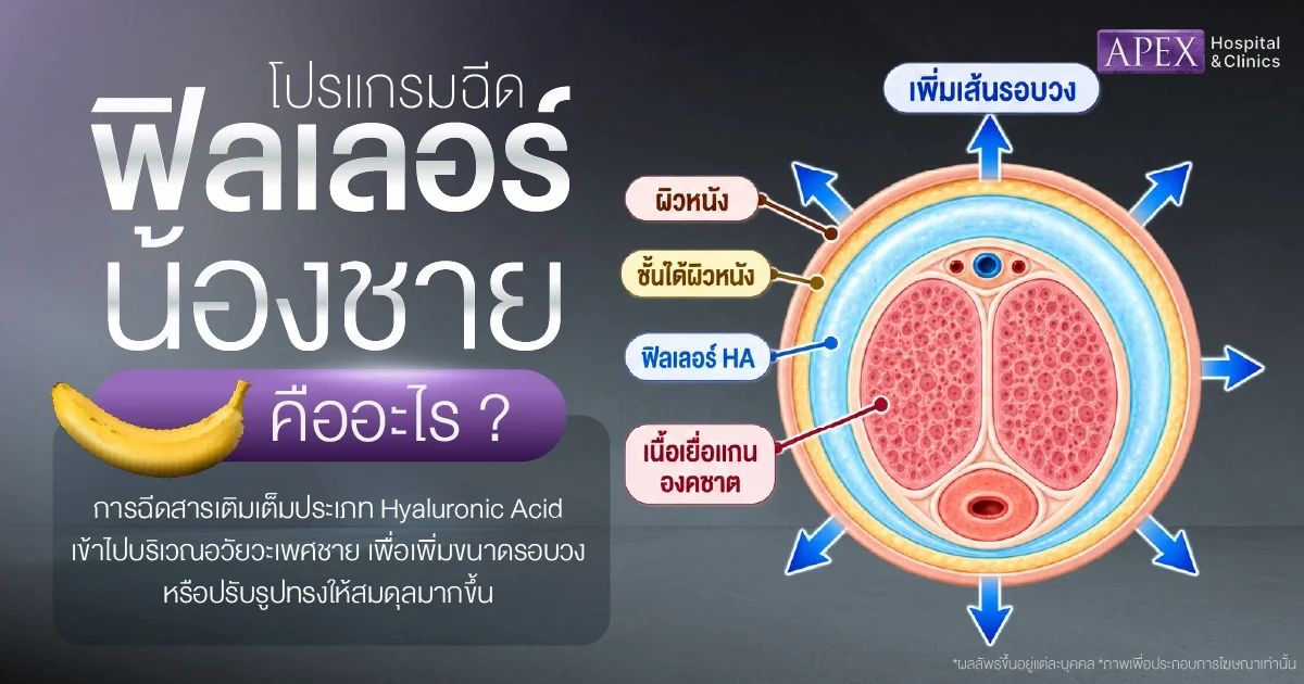 ฉีดฟิลเลอร์น้องชาย คืออะไร
