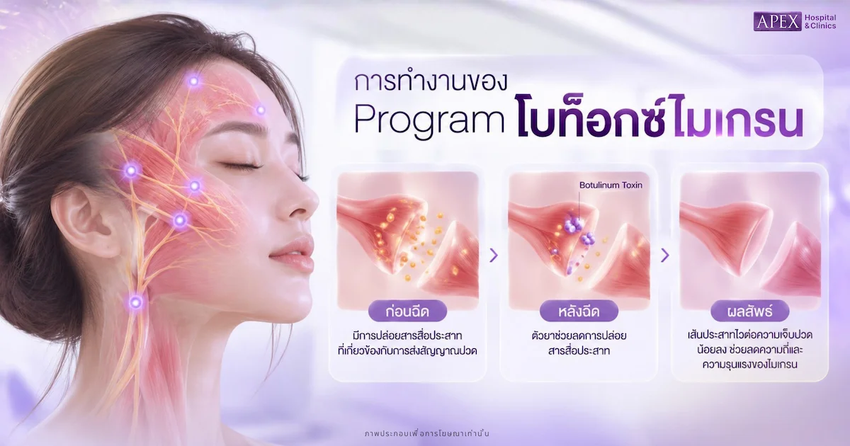 ทำไมโบท็อกถึงช่วยเรื่องไมเกรนได้