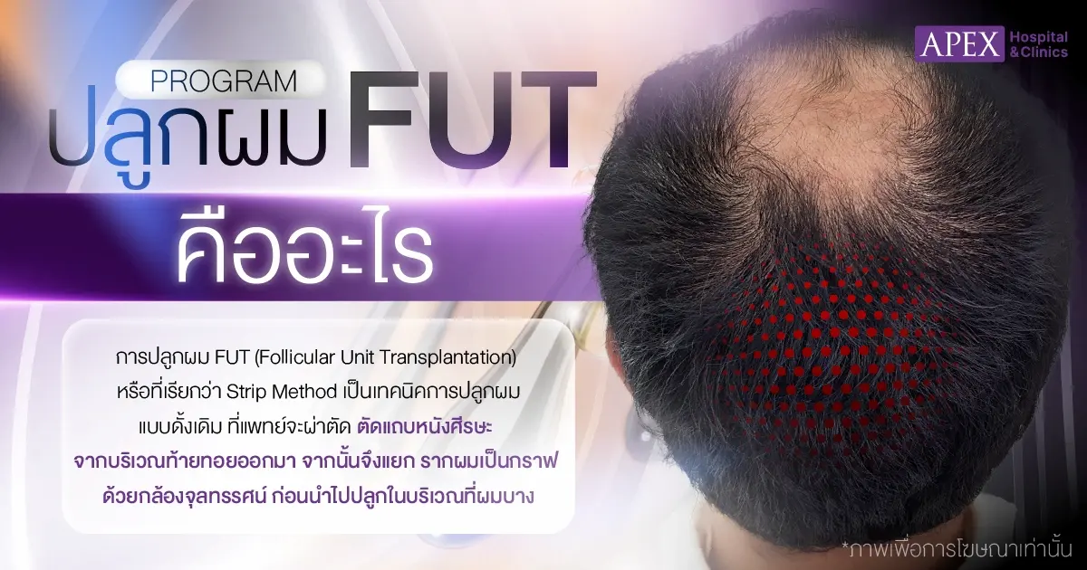 ปลูกผม FUT คืออะไร
