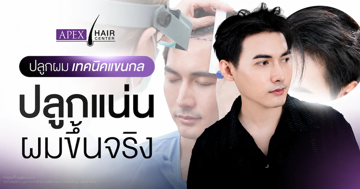 ปลูกผมเทคนิคแขนกล (Robotic Hair Transplant)