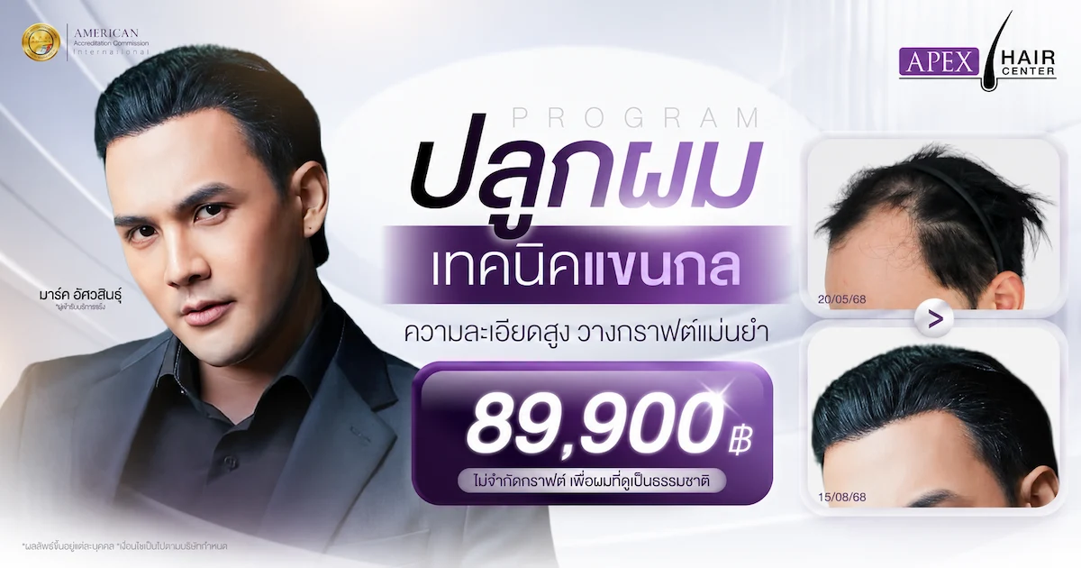 ปลูกผมเทคนิคแขนกล ราคา 89,900 บาท