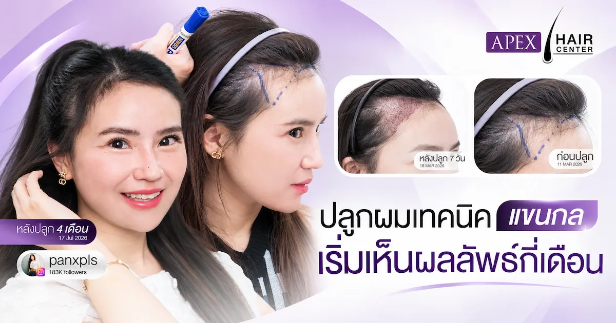 ปลูกผมเทคนิคแขนกล เห็นผลลัพธ์กี่เดือน