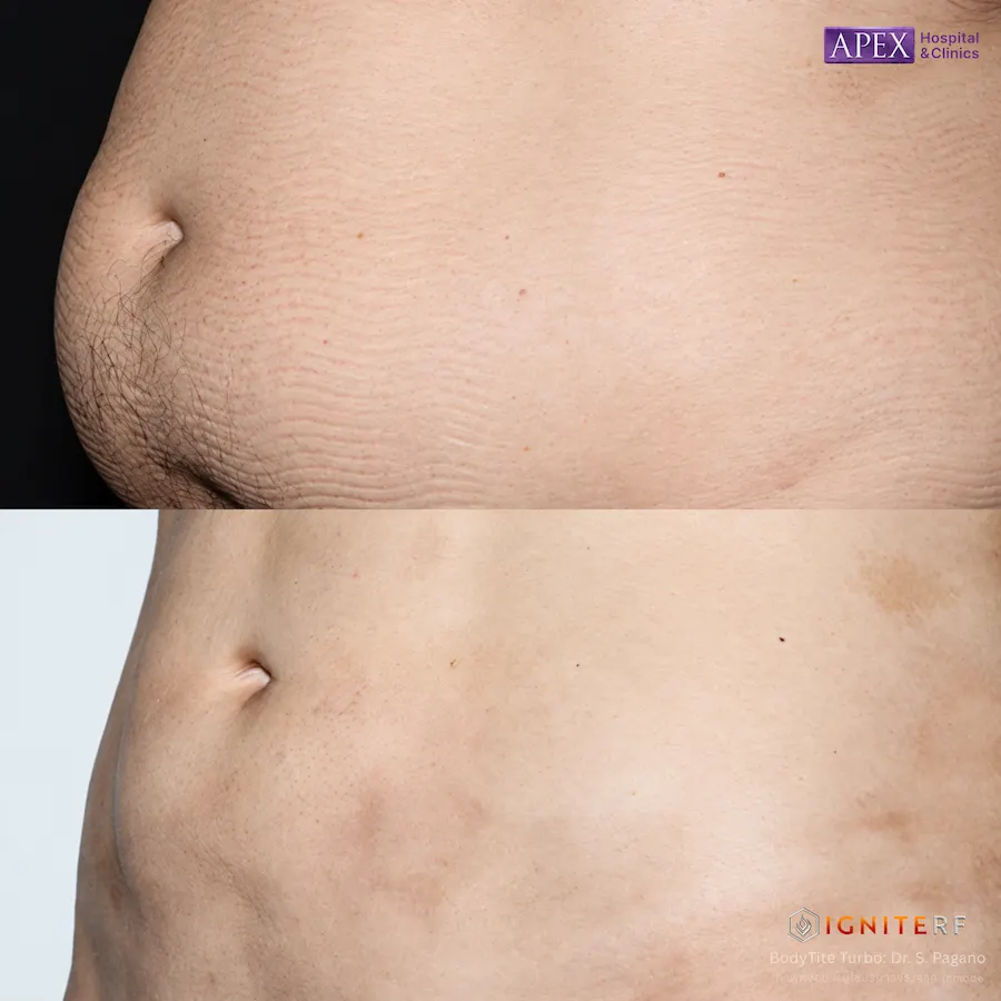 รีวิว BodyTite Turbo และ FaceTite Turbo