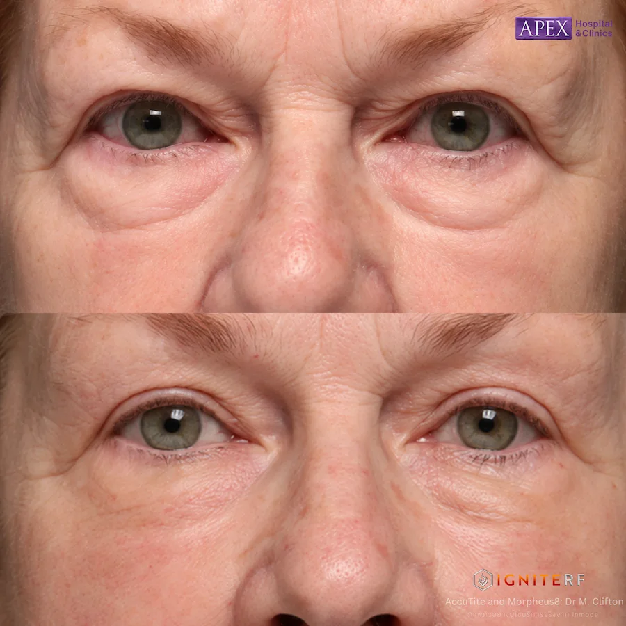 รีวิว IgniteRF หัว AccuTite