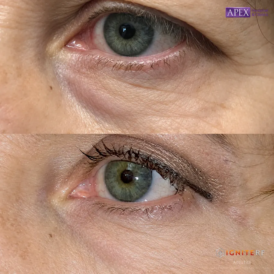 รีวิว IgniteRF หัว AccuTite
