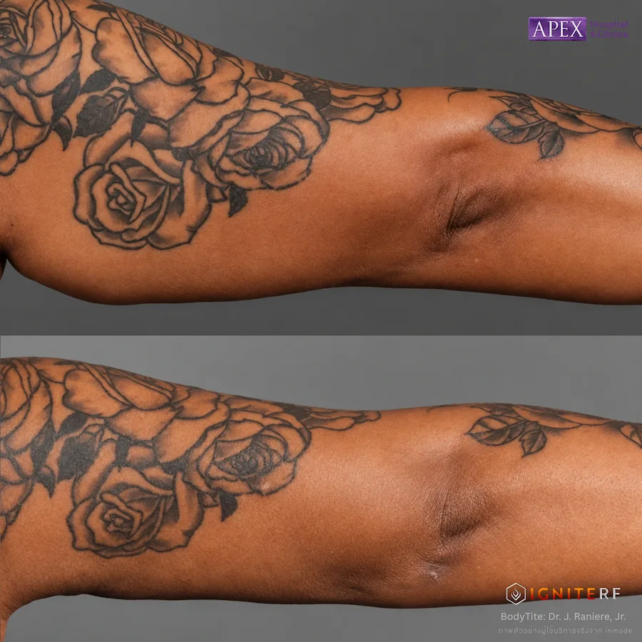 รีวิว IgniteRF หัว BodyTite