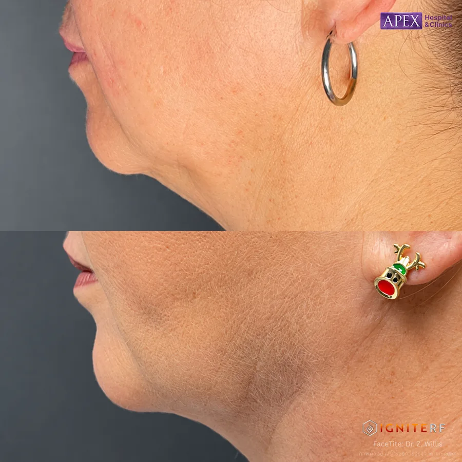 รีวิว IgniteRF หัว FaceTite