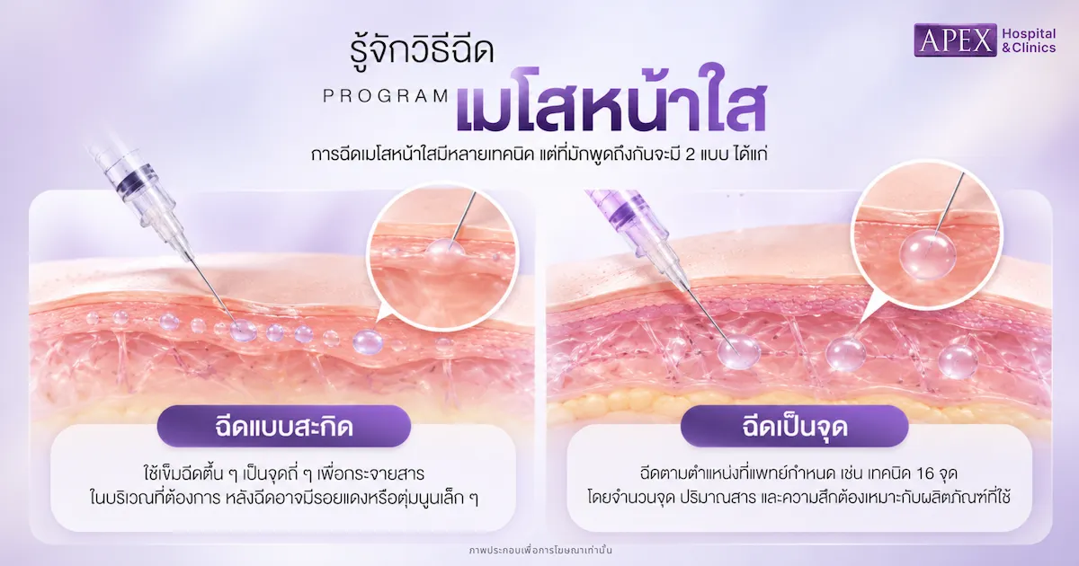 วิธีการฉีดเมโสหน้าใส