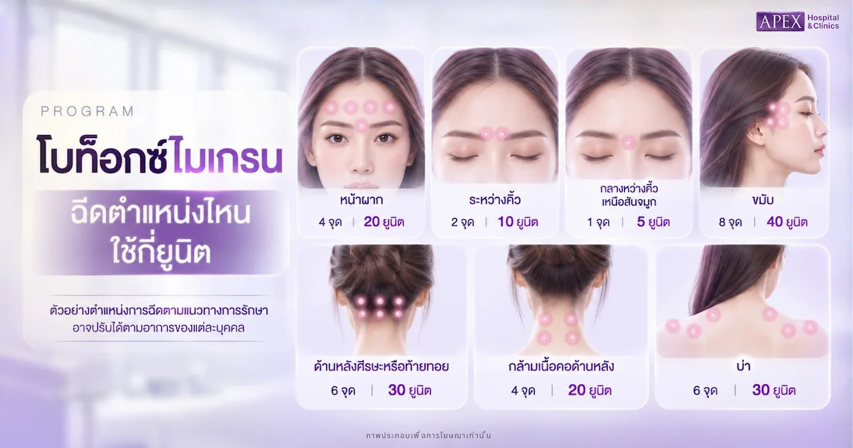 โบท็อกไมเกรนฉีดตำแหน่งไหน