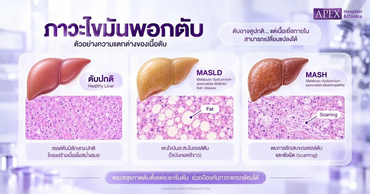 ไขมันพอกตับมีกี่ระยะ